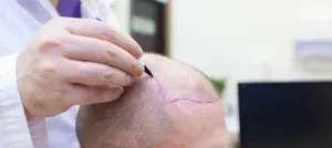 Hair Transplants in Young Men