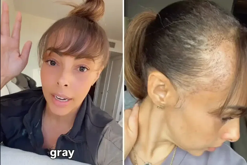 Hair Transplant Shocking Side Effect