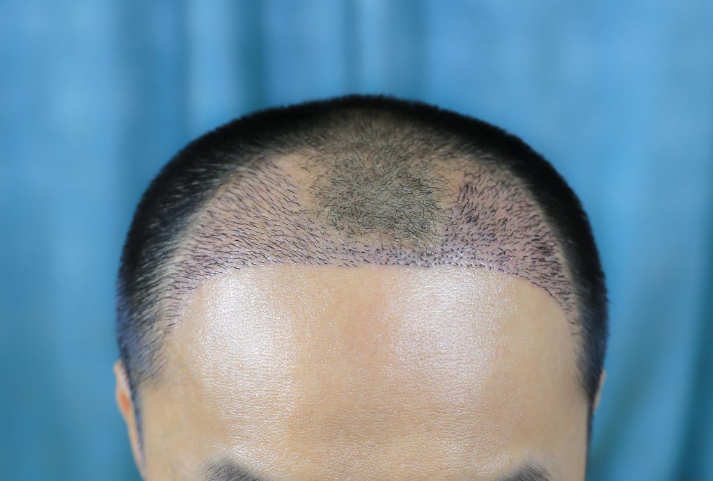 Surgeons Call Hair Transplant Industry the “Wild West” as Botched Procedures Rise